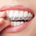 How Often Should You Visit the Dentist After Getting Invisalign Clear Braces?