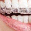 What Types of Teeth Can Be Treated with Invisalign Clear Braces?