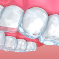 What Can I Do to Ease Pain and Discomfort from Invisalign Clear Braces?