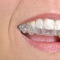 Straighten Your Teeth Invisibly: Invisalign Clear Braces In North Kansas City