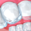 What to Do if You Experience Pain or Discomfort After Getting Invisalign Clear Braces