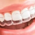 Achieve Your Dream Smile: Discovering Invisalign Clear Braces In Cedar Park