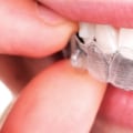 Can I Use Whitening Toothpaste with Invisalign Clear Braces?