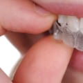 What to Do in an Emergency While Wearing Invisalign Clear Braces