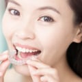 Brushing and Flossing with Invisalign Clear Braces: A Guide