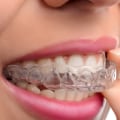 Are Clear Braces a Better Option than Invisalign?