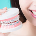 Affordable Alternatives to Invisalign Clear Braces