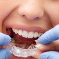 Can You Get Invisalign Clear Braces Without Visiting a Dentist?