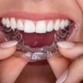 Achieving A Confident Smile: The Benefits Of Invisalign Clear Braces In Georgetown