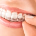 Straighter Smiles With Invisalign Clear Braces From Summerville’s General Dentist