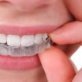 Straighten Your Teeth Discreetly With Invisalign Clear Braces In Commerce City
