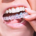 How Invisalign Clear Braces Can Transform Your Smile In Dripping Springs, TX