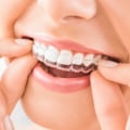 How Long Does it Take to Get Invisalign Clear Braces?