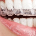 Transform Your Smile With Invisalign Clear Braces: A Dentist In Manassas Park, VA, Offers The Best Solution
