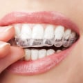 What Are the Risks of Invisalign Clear Braces?