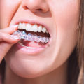 Relieving Discomfort from Invisalign Clear Braces with Dental Wax