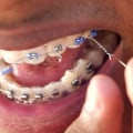What to Do When Your Invisalign Braces Wire or Bracket Becomes Loose