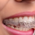 Can I Eat and Drink with Invisalign Clear Braces?