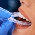 Why Refinement Stages Are More Common Than Many Invisalign Patients Expect