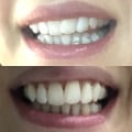 Why Some Invisalign Cases Require More Refinement Stages Than Expected