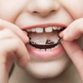 Clear Braces Without The Hassle: Invisalign For Children's Dentistry In Mcgregor, TX