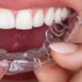 A Clear Choice For Straighter Teeth: Invisalign Clear Braces In Austin