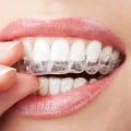 Discover The Power Of Invisalign Clear Braces: Your Path To A Beautiful Smile With A Cosmetic Dentist In Conroe