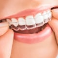 The Benefits of Invisalign Clear Braces: A Comprehensive Guide