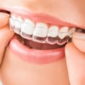 Straighten Your Teeth With Invisalign Clear Braces In Austin