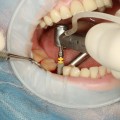 Invisalign and Dental Implant Surgery: A Guide for Patients