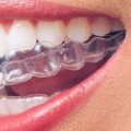 Why Spring, TX Adults Are Choosing Invisalign Clear Braces For A Confident Smile