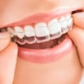 How Long Does It Take to Straighten Teeth with Invisalign Clear Braces?