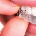 Caring for Your Invisalign Clear Braces: A Guide