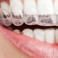 How Long Does It Take to Get Invisalign Clear Braces Removed?
