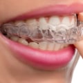 Can I Use Over-the-Counter Pain Relievers for Invisalign Clear Braces?