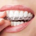 Do I Need to Visit the Dentist Regularly While Wearing Invisalign Clear Braces?