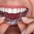 Can I Eat and Drink with My Invisalign Clear Braces?