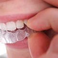 Invisible Orthodontics: Achieving A Perfect Smile With Invisalign Clear Braces In Austin