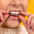 The Modern Approach To Straight Teeth: Invisalign Clear Braces In London