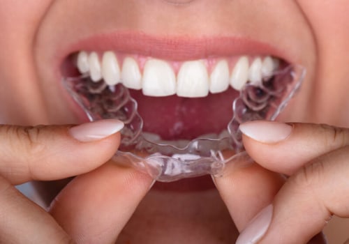 Achieve A Perfect Smile Discreetly: Exploring Invisalign Clear Braces In Sydney