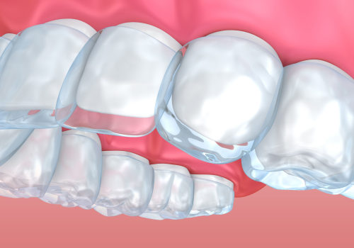 What Can I Do to Ease Pain and Discomfort from Invisalign Clear Braces?