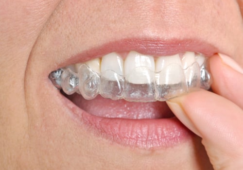 Straighten Your Teeth Invisibly: Invisalign Clear Braces In North Kansas City