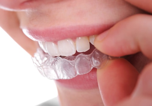 The Intersection Of Invisalign And Sleep Apnea Dentistry In Hillsboro: A Winning Duo