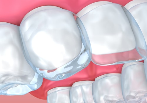 What to Do if You Experience Pain or Discomfort After Getting Invisalign Clear Braces