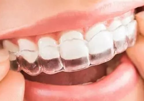 Achieve Your Dream Smile: Discovering Invisalign Clear Braces In Cedar Park