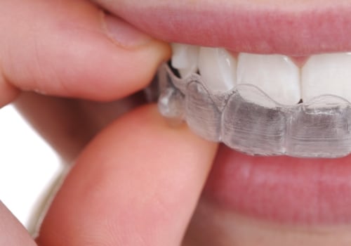 What to Do in an Emergency While Wearing Invisalign Clear Braces