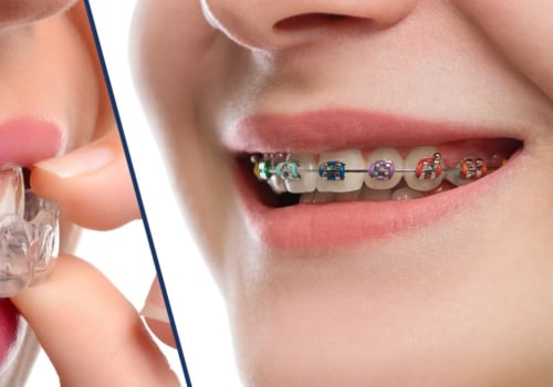 Are Clear Braces a Better Option than Invisalign?
