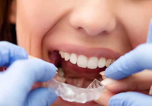 Can You Get Invisalign Clear Braces Without Visiting a Dentist?