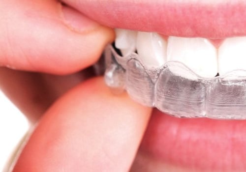 Can I Wear Other Orthodontic Appliances with My Invisalign Clear Braces?