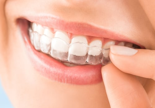 Straighter Smiles With Invisalign Clear Braces From Summerville’s General Dentist